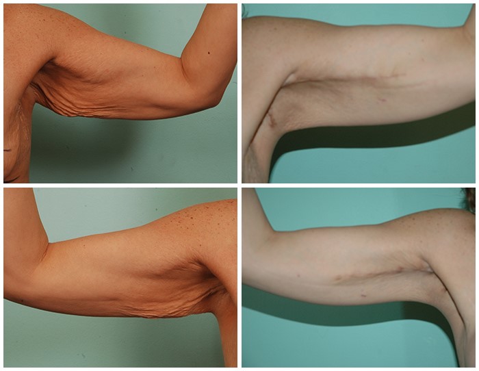 قبل و بعد از جراحی بازو با لیزر