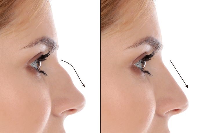 انجام جراحی زیبایی بینی با توجه به تناسب بینی با سایر اجزای صورت