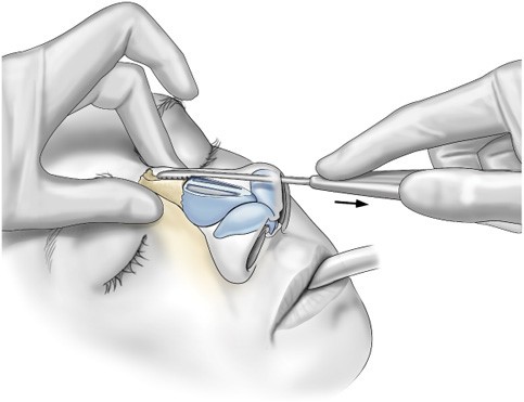 جراح متخصص طبق اندازه قوز بینی و ویژگی‌های مورفولوژیکی از سوهان مناسب استفاده می‌کند.